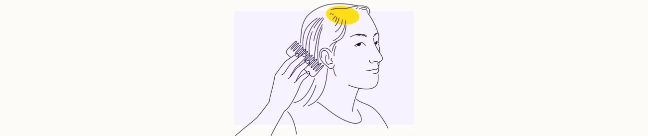 Alopecia Hair Loss Signs Types Triggers