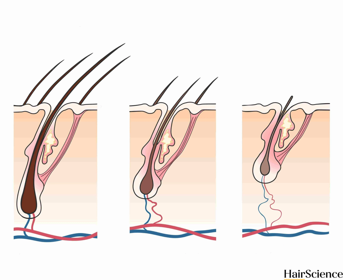 DHT Hair Follicle Miniaturization