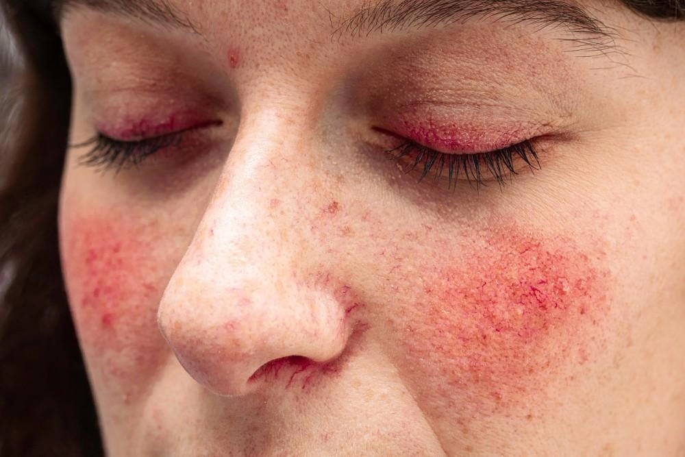 Emotional Coping with Rosacea