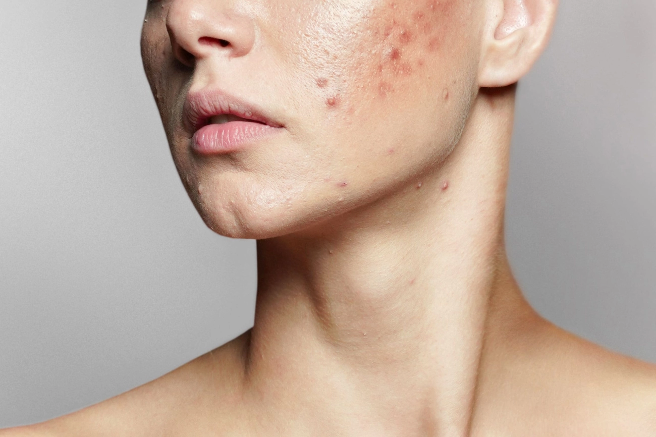 Rosacea Food Triggers and Management