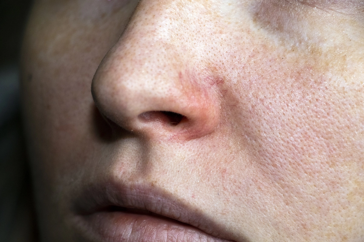 Rosacea Stages from Redness to Rhinophyma