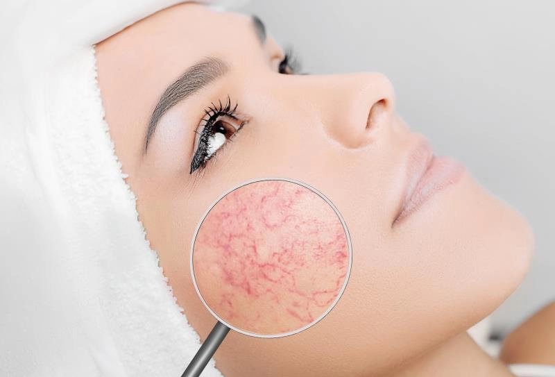 Rosacea Treatment Clinics Hong Kong