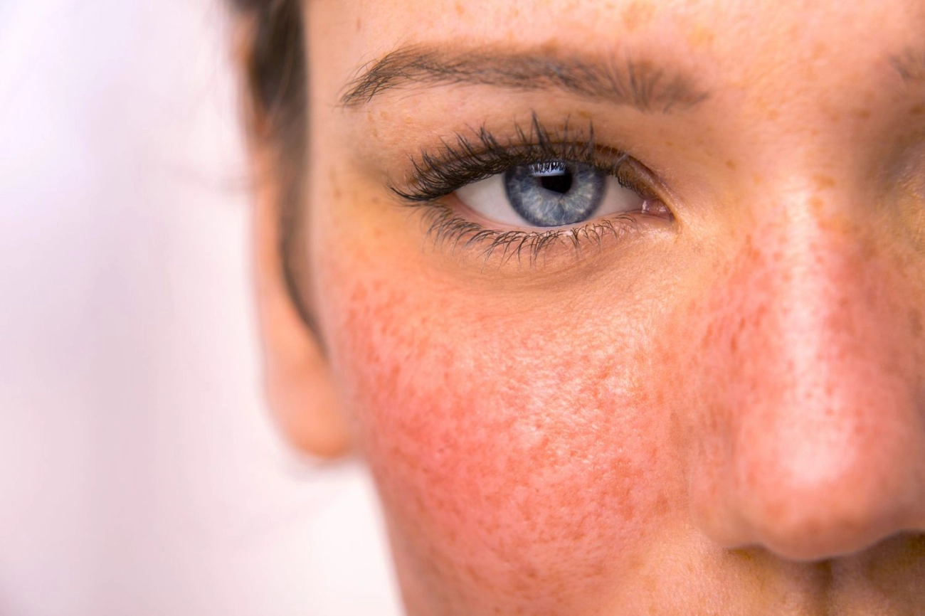 Rosacea Treatment Selection Guide